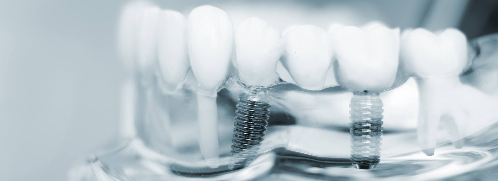 Implants Dentist in Acton